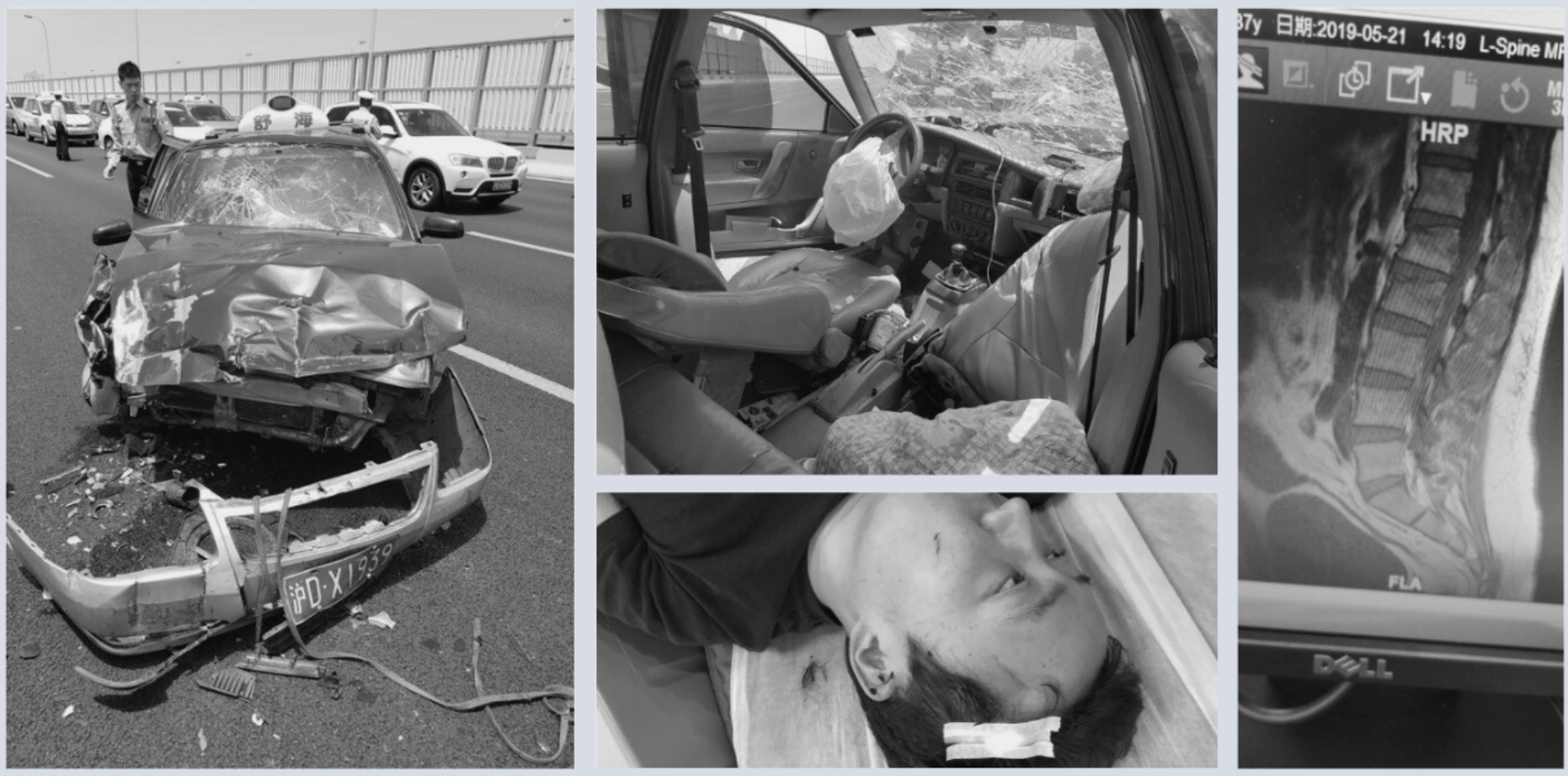 Photographs from the 2019 car crash: the wrecked taxi, the crushed interior, David on a stretcher, and a spinal MRI
